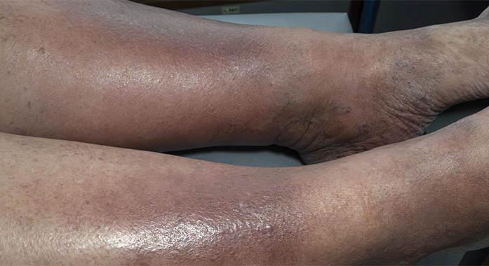 Vénás eredetű bőrgyulladás (stasis dermatitis)