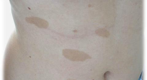 Korai felismerés és gondozás gyermekkori neurofibromatosisban