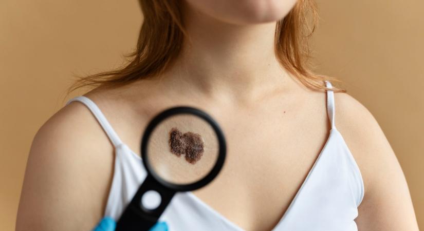 Kik vannak a leginkább kitéve a bőrrák kockázatának? Ne becsüld alá ezt a 6 figyelmeztető jelet