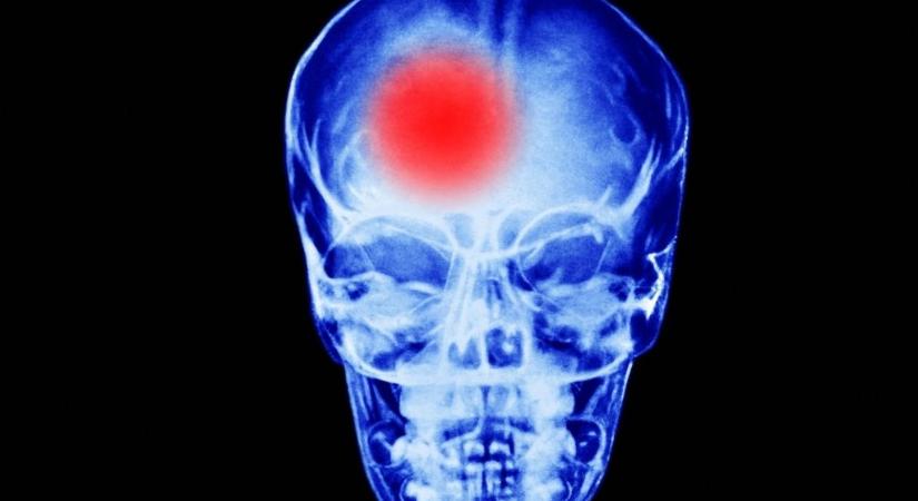 25 év felett minden negyedik felnőttet érinthet élete során a stroke – ezeknél a jeleknél azonnal mentőt kell hívni