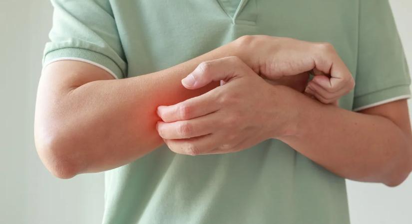 Bőrviszketéstől szenvedsz? Súlyos betegség jele lehet