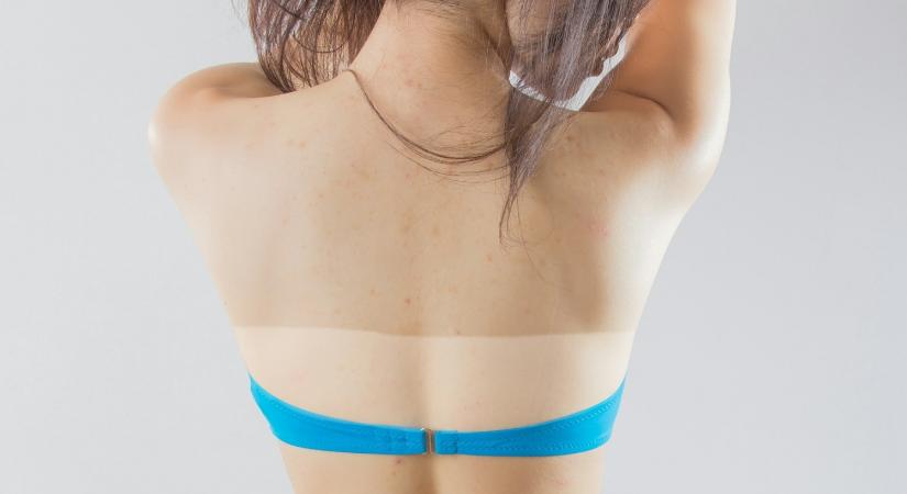 Hadüzenet a pusztító trendeknek a melanoma elleni küzdelemben