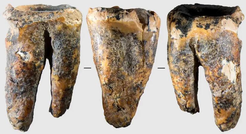 59 ezer évvel ezelőtti fogműtét nyomait hordozhatja egy neandervölgyi fog