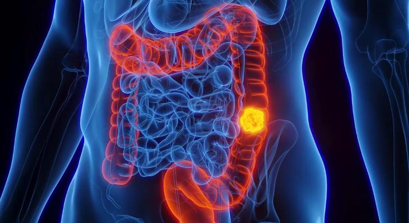 Áttörés a vastagbélrák ellen: tartós siker az immunterápiával