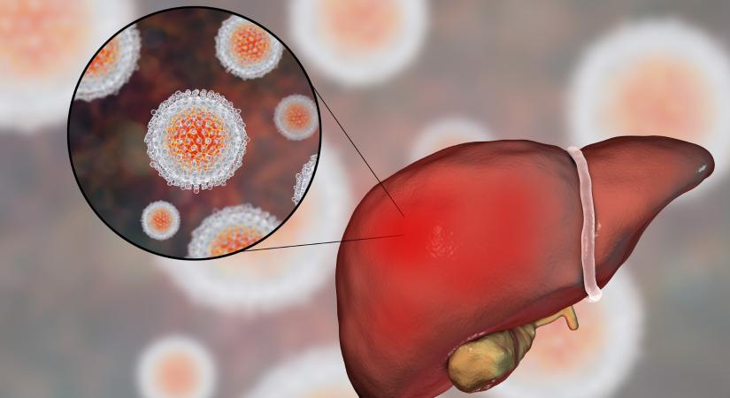 Zsírmáj ellen hatásos: egyetlen vitamin képes kitisztítani a májat