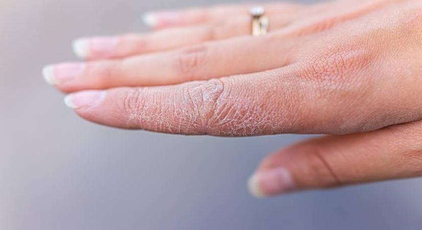 Ha te is ezt látod a kezeden, brutális vitaminhiányod lehet: talán nem is gondolnál erre