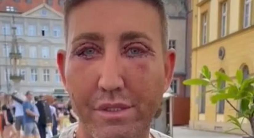 Plasztikai beavatkozások függője lett az X-Faktor sztárja, mára már felismerhetetlen