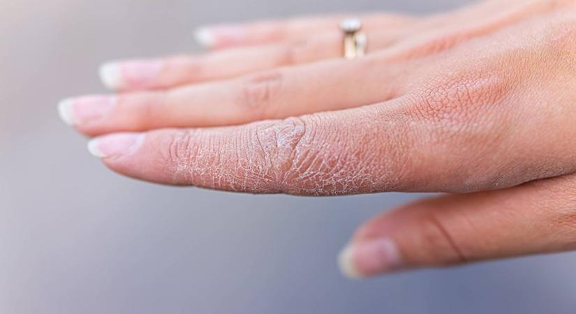 Ha te is ezt látod a kezeden, brutális vitaminhiányod lehet