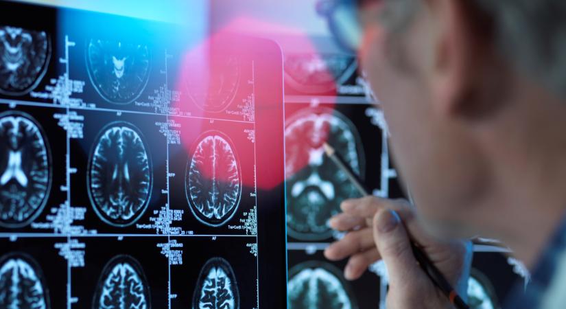 Áttörés jöhet az Alzheimer-kór kezelésében – Ígéretes gyógyszert fejlesztettek ki