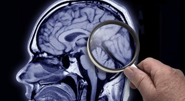 Ha mindennap eszel ebből, kisebb lesz az esélyed az Alzheimer-kórra