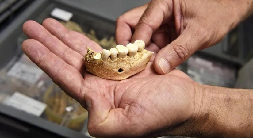 Megdöbbentő felfedezés: a neandervölgyiek közt is voltak fogorvosok