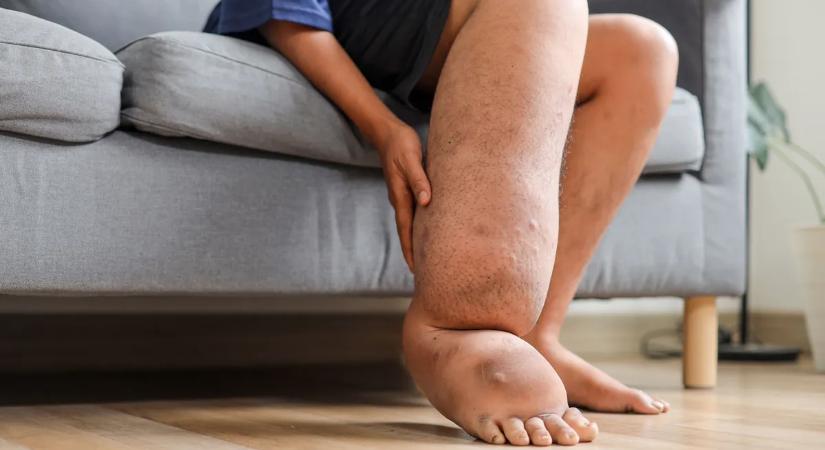 Egyetlen szúnyogcsípés eltorzítja a végtagjaidat – íme a sokkoló elefántkór