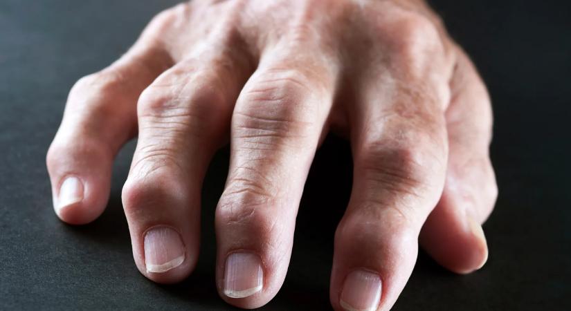 A sokízületi gyulladás kiváltó okaiként a depressziót, az alvászavarokat és az elhízást is azonosították magyar kutatók