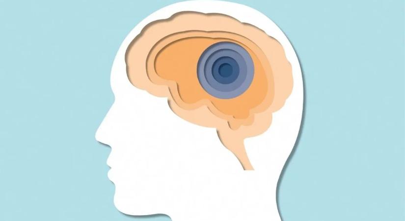 Vége a stroke-nak? Úgy tűnik, megvan az áttörés