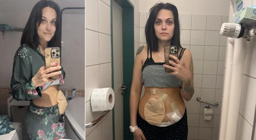 "Bármikor meghalhattam volna!" – örökre megváltoztatta egy műtét a kétgyermekes Anita életét