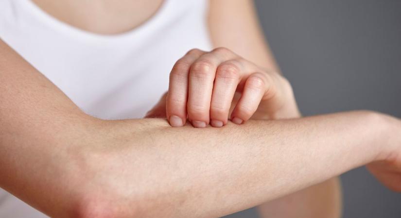 Azt hitte, ekcéma – kiderült, hogy az apró folt ritka vérrák tünete