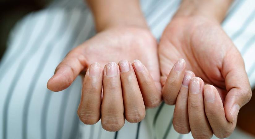 A máj betegsége is jól látszik a körmön: ezekre a jelekre figyelj oda
