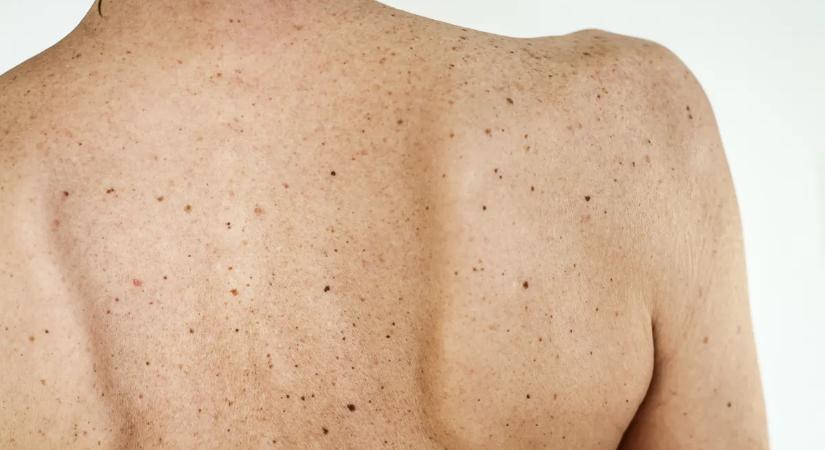 Két orvos is ártalmatlannak tartotta az anyajegyét – saját megérzése mentette meg a nő életét