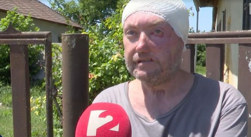 Leharapták a fülét, tönkretették az életét! Perre készül a mérai kutyatámadás áldozata - videóval
