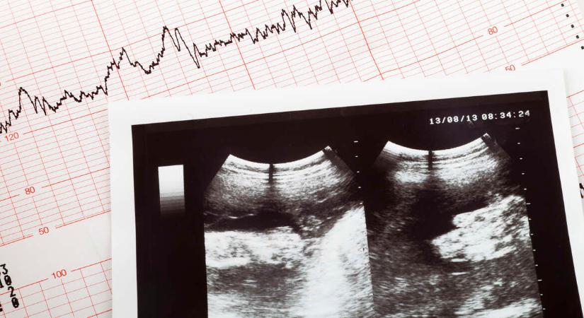 Szívhangrendelet: Várólisták és visszarendelések miatt csúszhattak ki nők a 12 hetes abortusz-határidőből