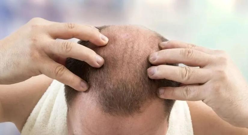 Így állíthatja meg a hajhullást természetes módon – milliók esküsznek erre a gyógynövényre