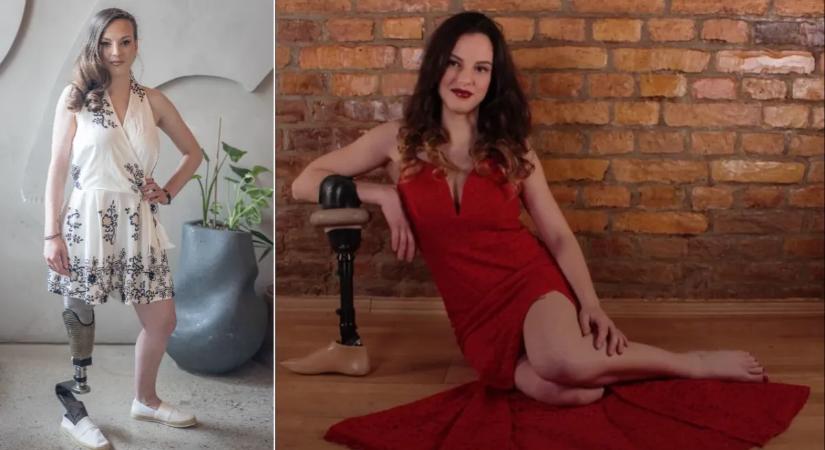 “17 évesen úgy döntöttem, hogy amputálják a lábamat” - Daniella számára megkönnyebbülés volt, hogy elvesztette jobb lábát