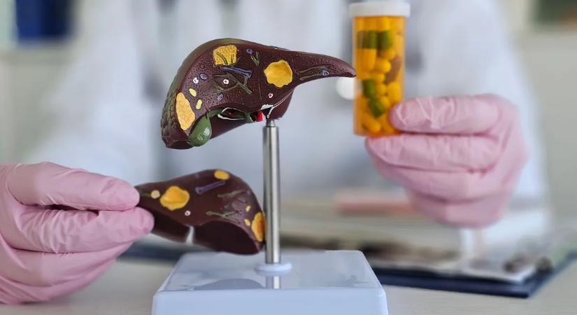 Zsírmáj és májzsírosodás: egy ismert vitamin bizonyult a leghatásosabbnak