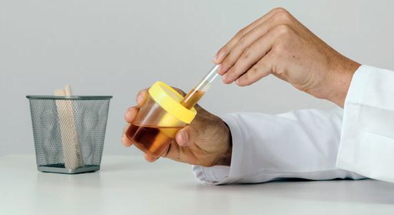 Megváltozott a vizelete? Ezek állhatnak a hátterében