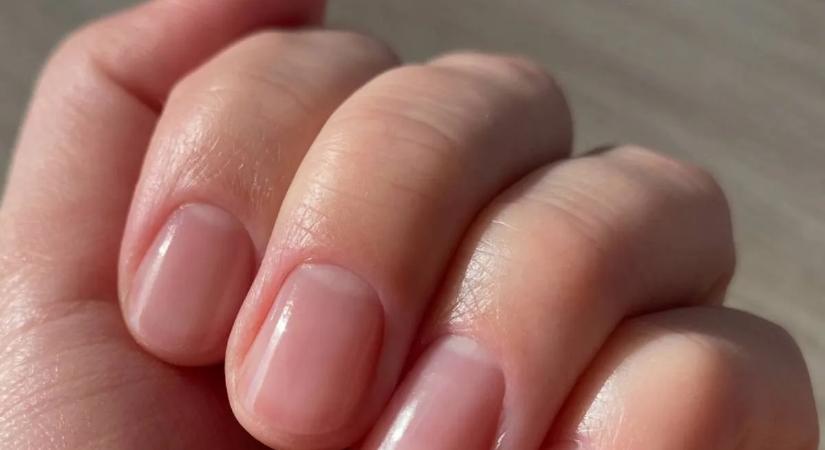 5 elváltozás a körmön, ami májbetegségre utalhat