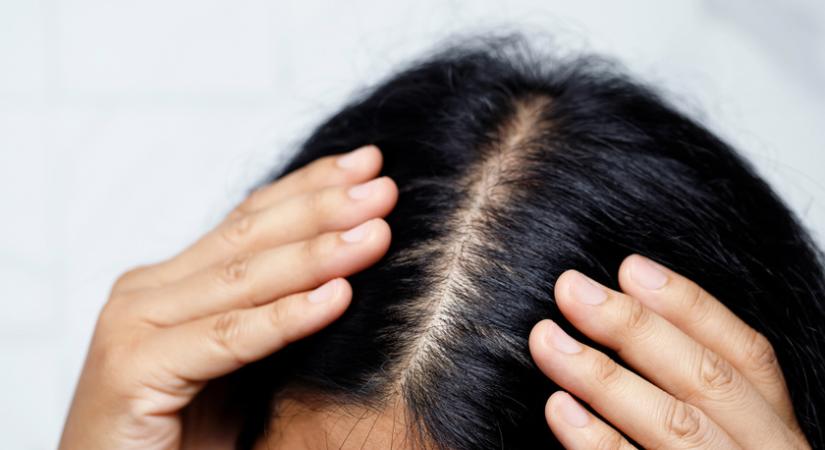 Hatásos lehet a férfias típusú hajhullás ellen a fűrészpálma? Hormonzavarok esetén is használják