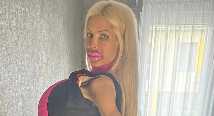 Újabb műtéten esett át Magyarország legnagyobb mellű nője, Baj Angelika