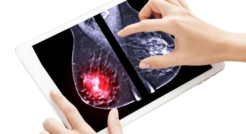 Áttörés a rák elleni küzdelemben – ez az új megoldás mindent megváltoztathat