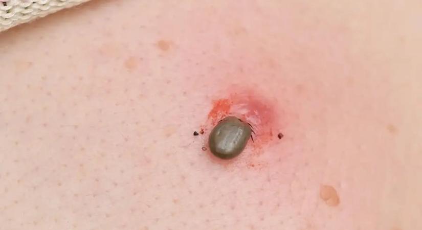 Kullancscsípés után ezt tedd azonnal: minden perc számít