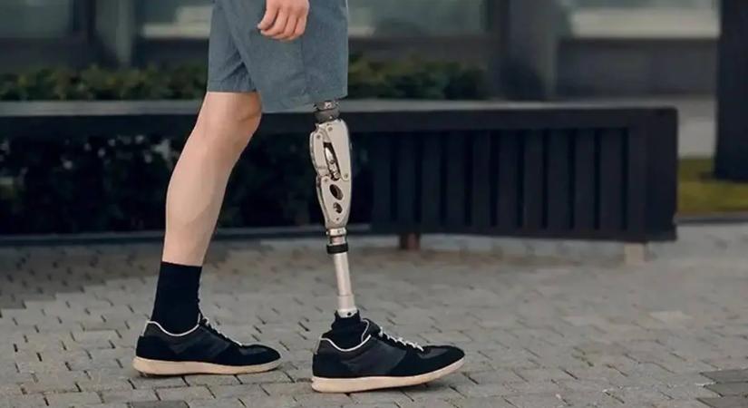 Az ukrajnai háborúban megsérült betegek kapnak művégtagot Budapesten egy humanitárius program keretében
