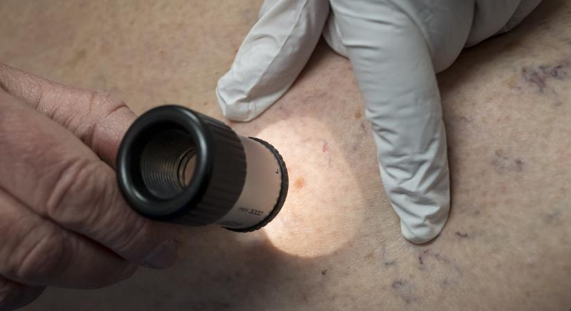Génmintázat-alapú bőrgyógyászati diagnosztikai lehetőséget dolgoztak ki az SZTE részvételével
