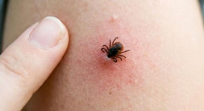 Gyermekorvos a kullancsokról: az eltávolítás otthoni feladat, nem orvosi