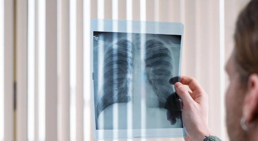 Itt a bejelentés: összefüggést találtak bizonyos ételek és a tüdő egészsége között