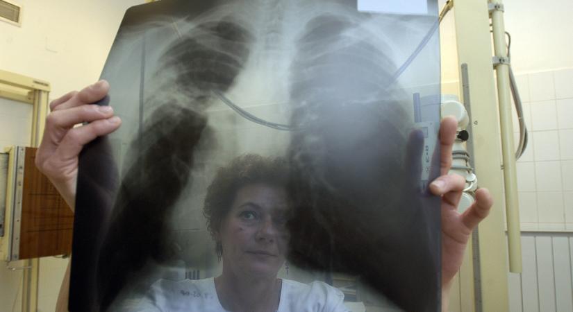 Rendszeres tüdőszűréssel megelőzhető a nagyobb baj