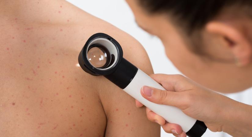 UV-sugárzás, legyengült immunrendszer – Hogyan tehetünk a melanoma rizikófaktorai ellen?