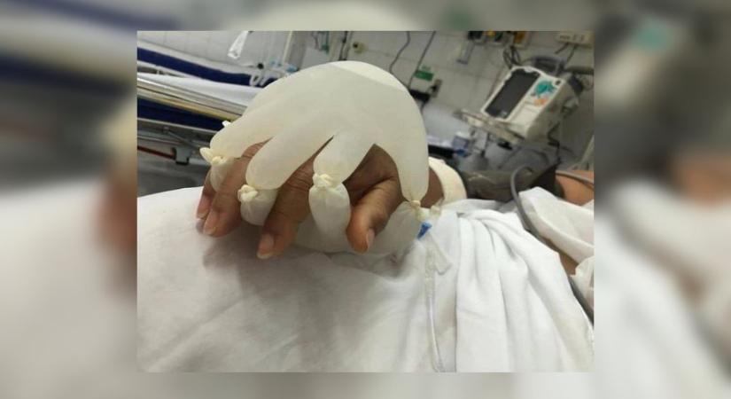 Meleg vízzel töltött gumikesztyűkkel fogják a magányos covidos betegek kezét egy brazil kórházban