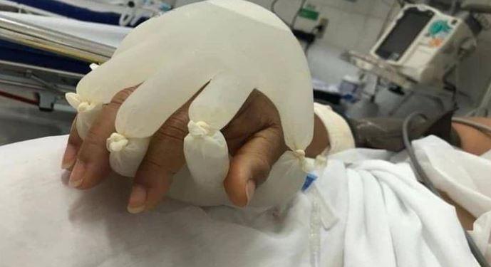 Meleg vízzel töltött gumikesztyűkkel fogják a covid-betegek kezét egy brazil kórházban