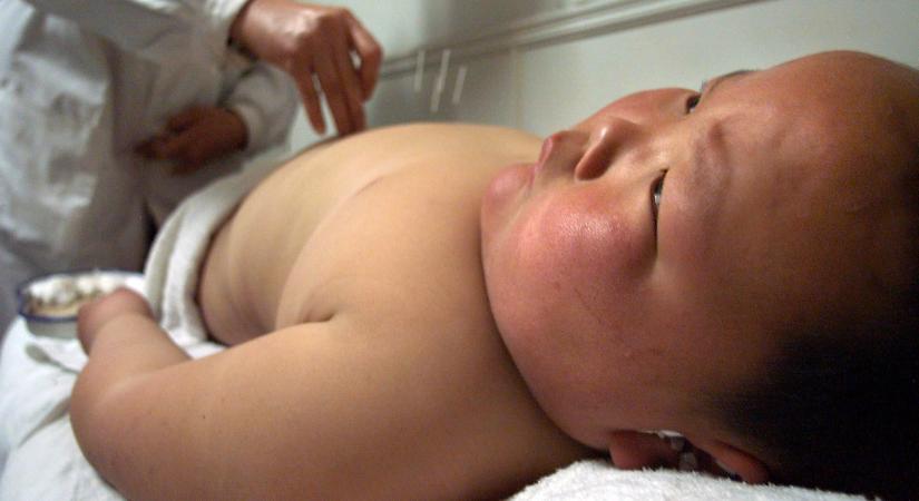 Az akupunktúra jó hatással lehet a kólikás csecsemőkre