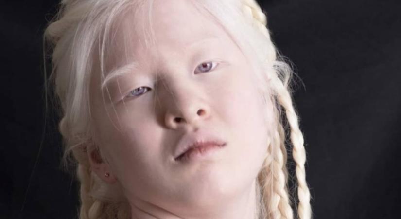 Sorsára hagyták az albínó kisbabát, 16 évvel később a Vogue modellje lett