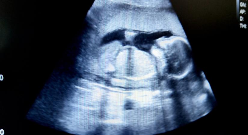 Az abortusz ellenére élve jött világra a csecsemő, akinek haláltusáját édesanyja is végignézte