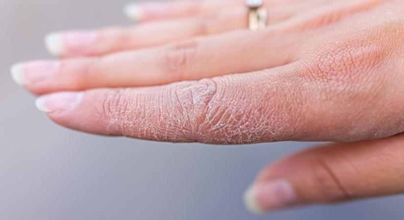 A száraz, repedezett kéz gyakori okai: nem csak a kézfertőtlenítő lehet a hibás