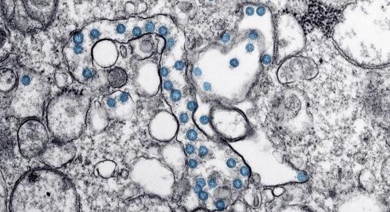 Videón, ahogy a koronavírus megfertőzi a sejteket