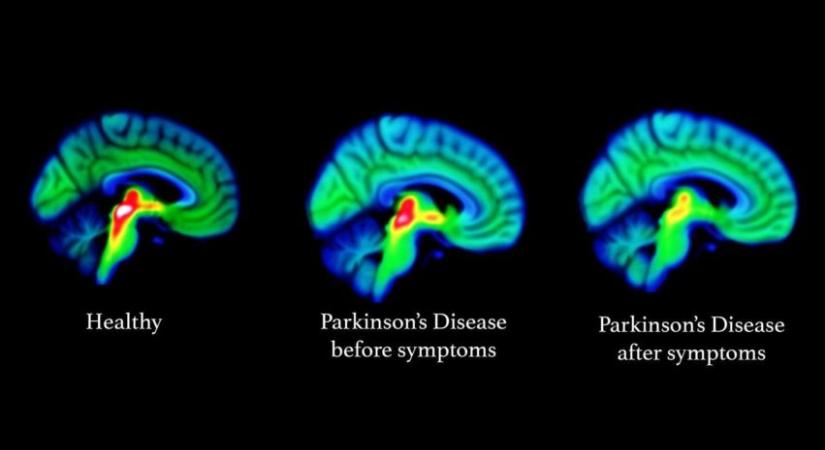 Megtört a jég a Parkinson-kór elleni harcban