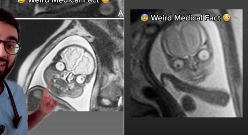 Megmutatta egy orvostanhallgató, milyen ijesztő a babák feje az MRI-felvételeken