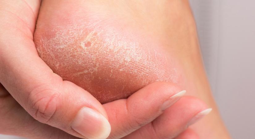 A bőrkeményedés is jelezhet lábbetegséget: nem csak a magas sarkú cipő okozhatja