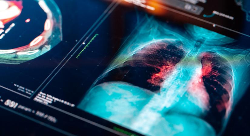 Ingyenes tüdőrákszűrés indult az 50 év felettieknek: itt lehet jelentkezni a vizsgálatra